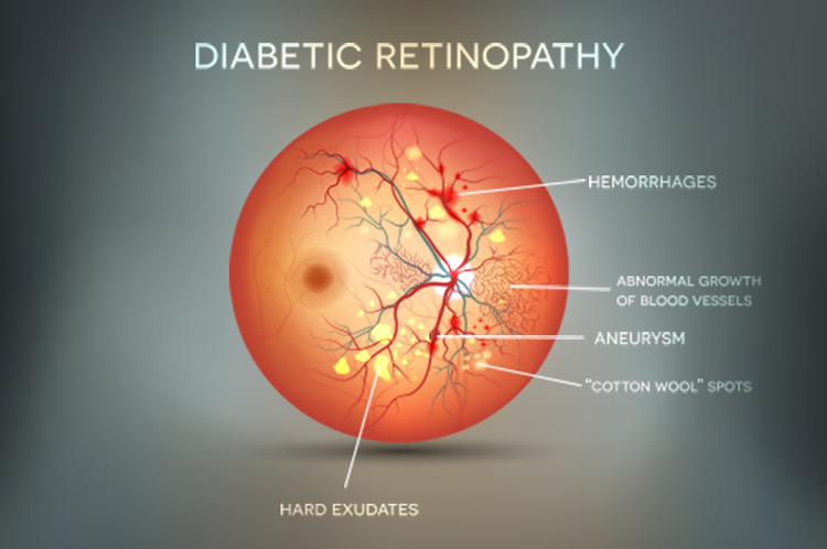 Ophthalmology 360 | Consider This Algorithm for Proliferative Diabetic ...