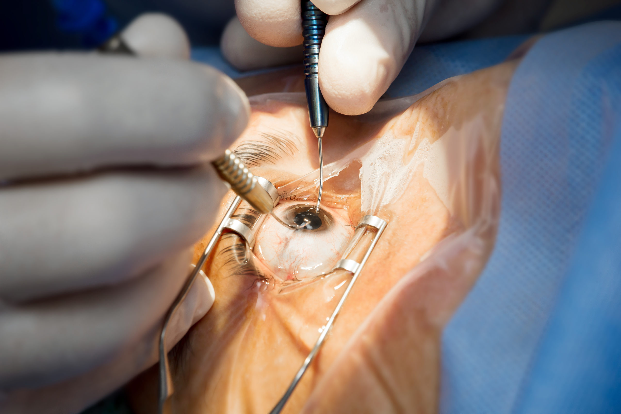 cataract eye surgery