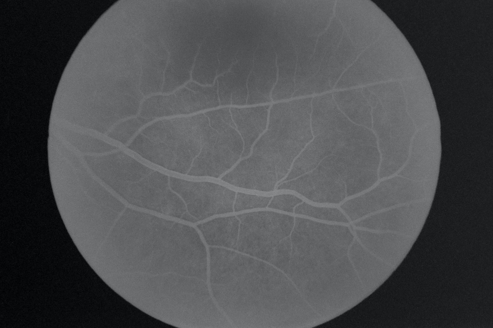 Fluorescein angiography of eye disease in the foreground
