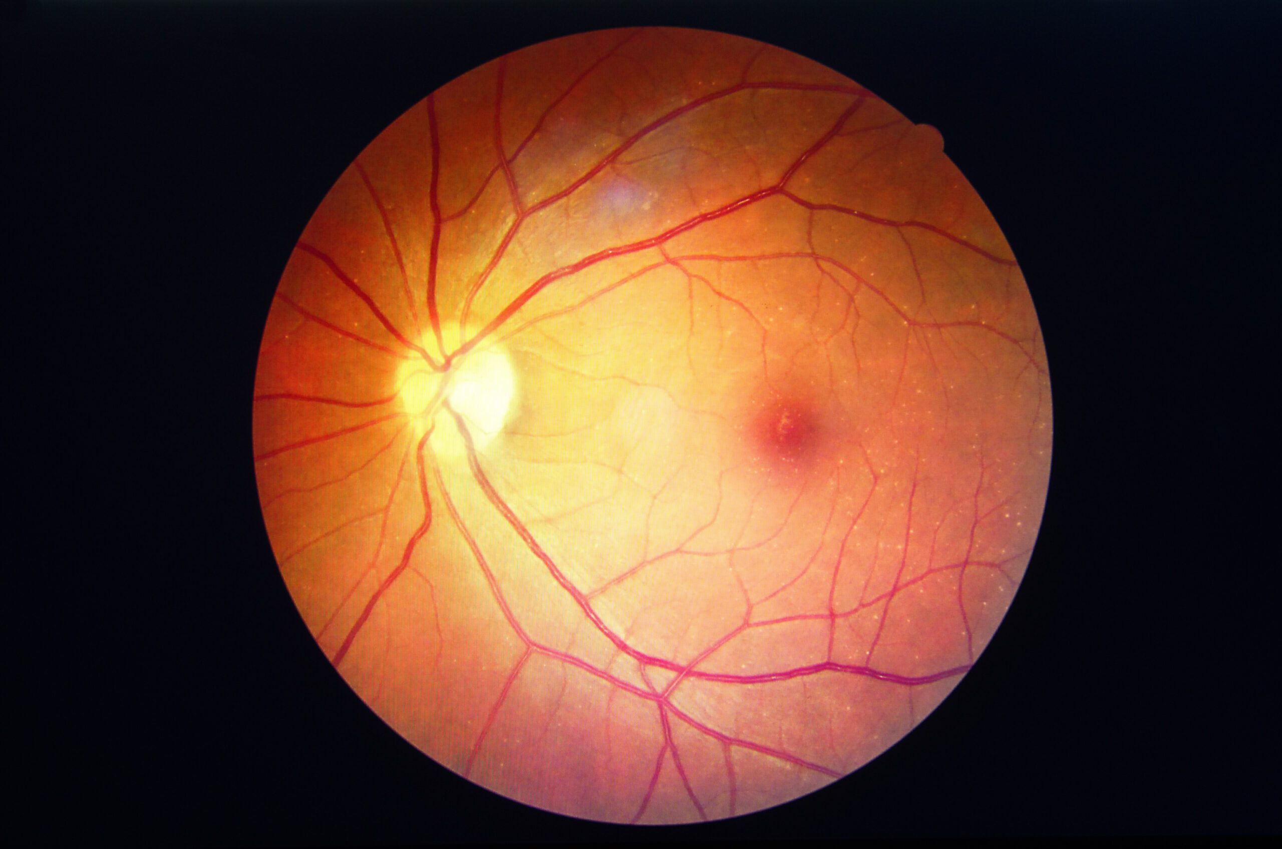 diabetes retinopathy.