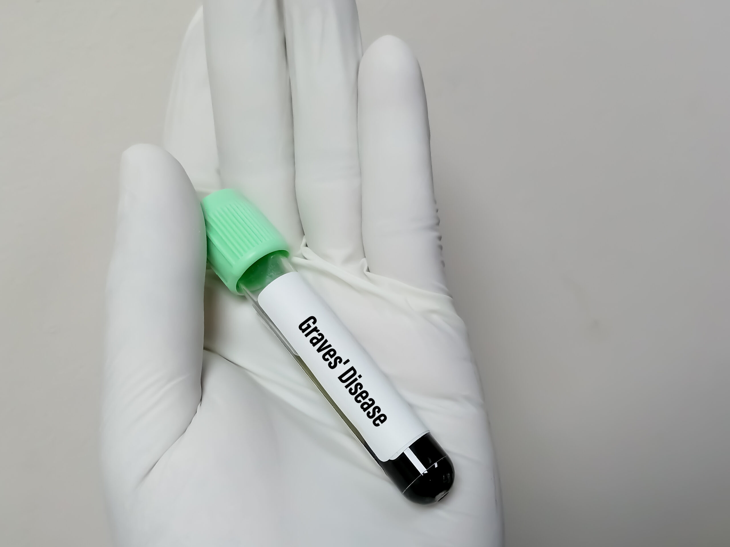 Blood sample tube for Graves’ disease test at medical laboratory. Autoimmune disease that affects the thyroid gland. The gland produces too much thyroid hormone