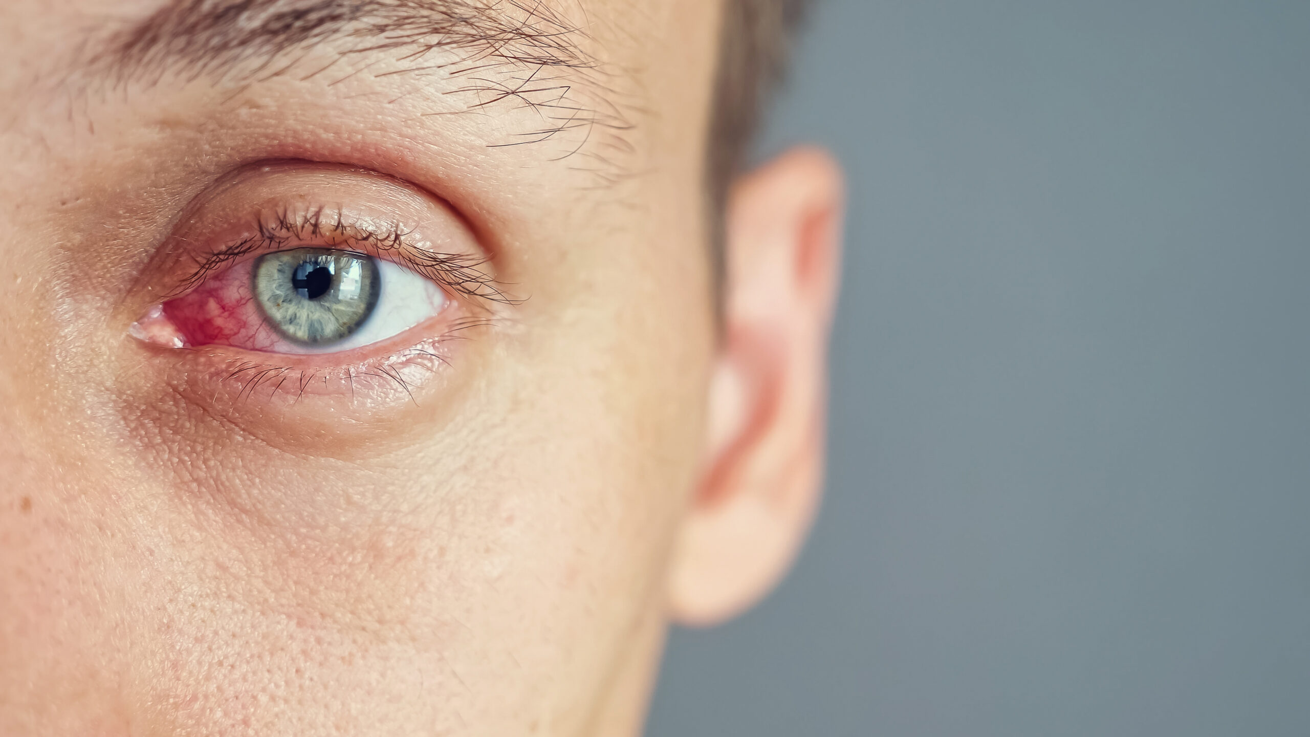 Close-up of the red eye of a man affected by an infection