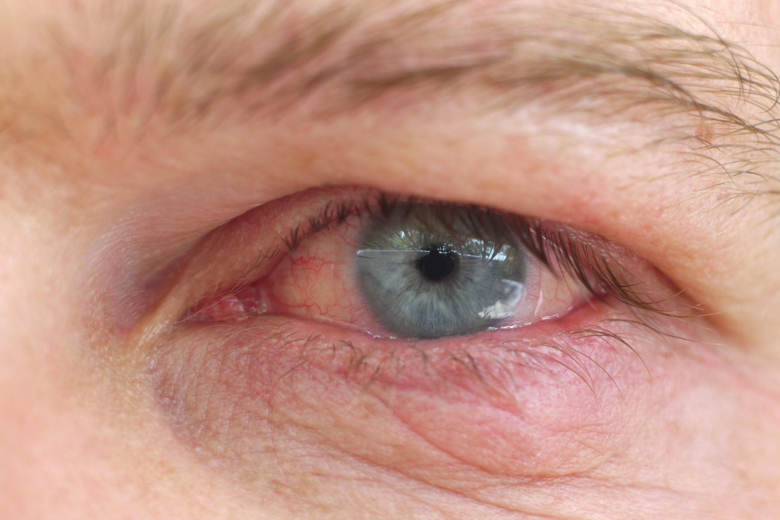Eye infection / Infection of an eyelid on an eye with contact lens