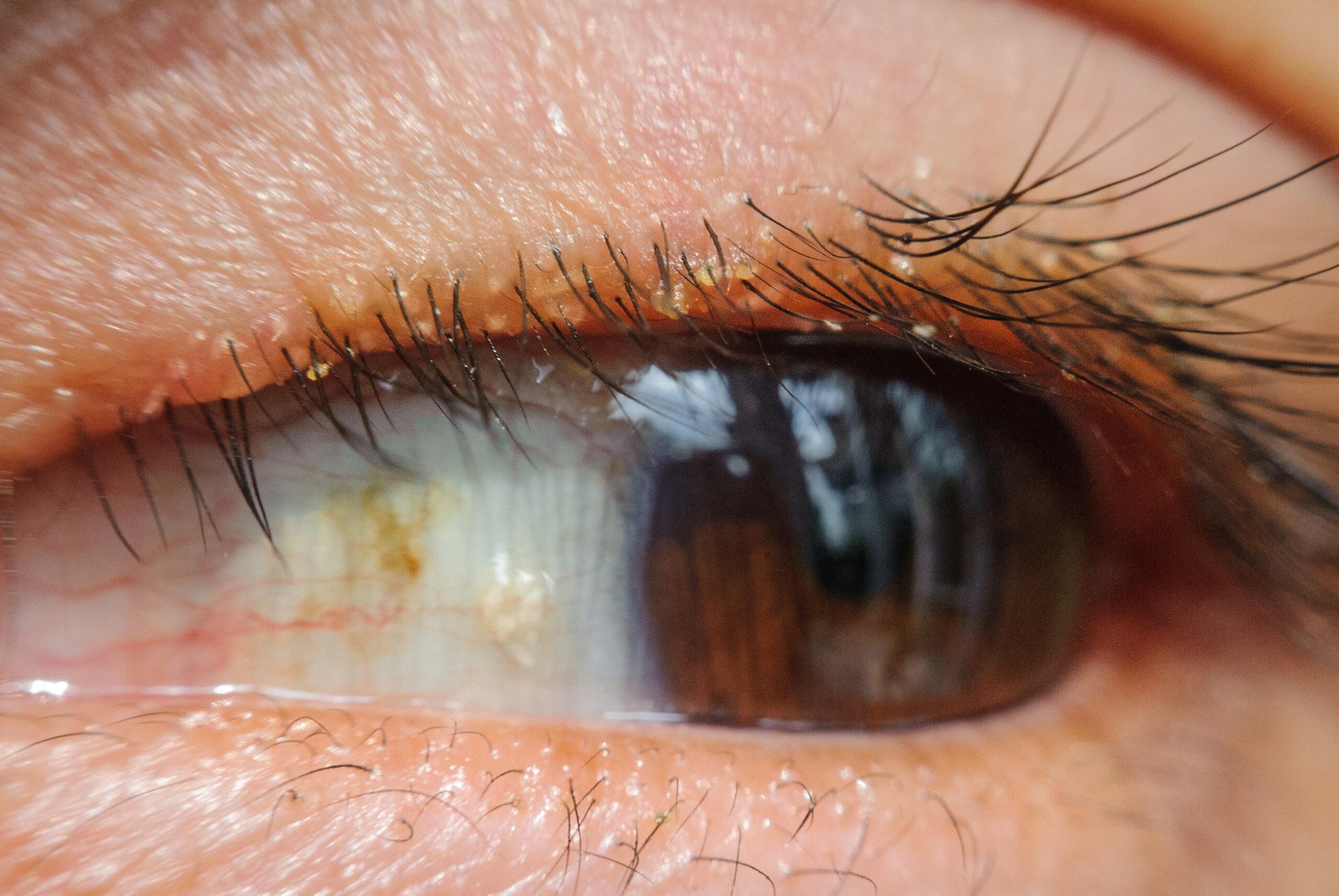 close up Blepharitis or Eyelid inflammation eyes healthy concept