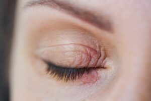 Demodex blepharitis