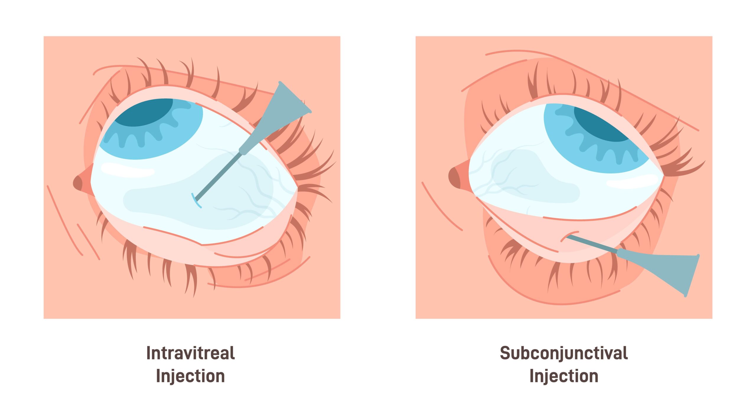 intravitreal injection