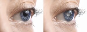 glaucoma progression
